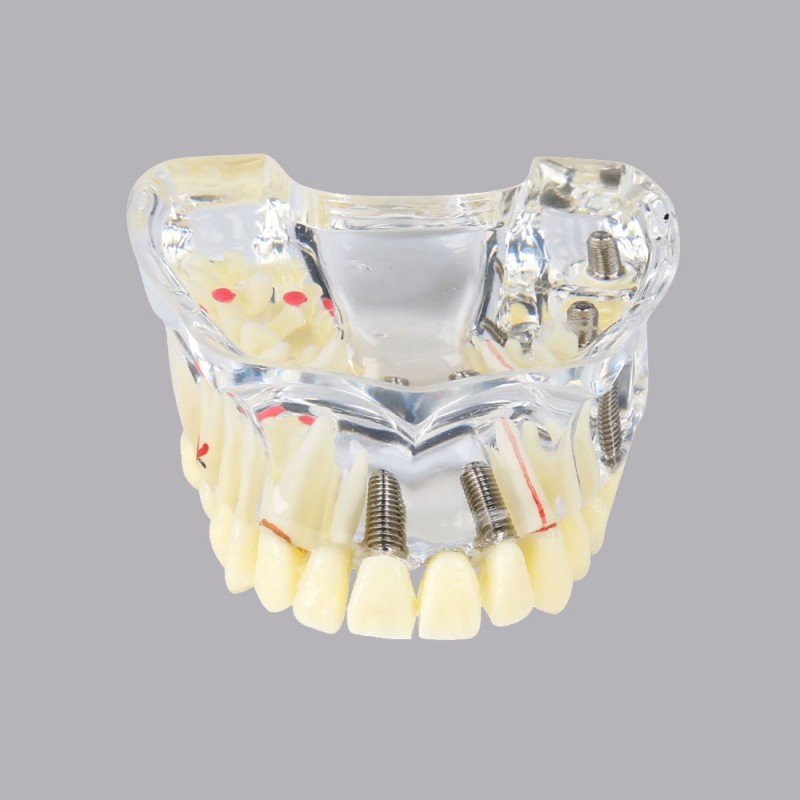 Implant model with soft gingiva and bridge - Image 4