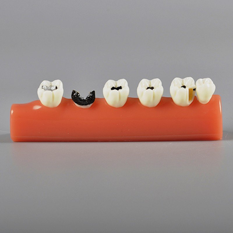 Caries Illustration Model - Image 3