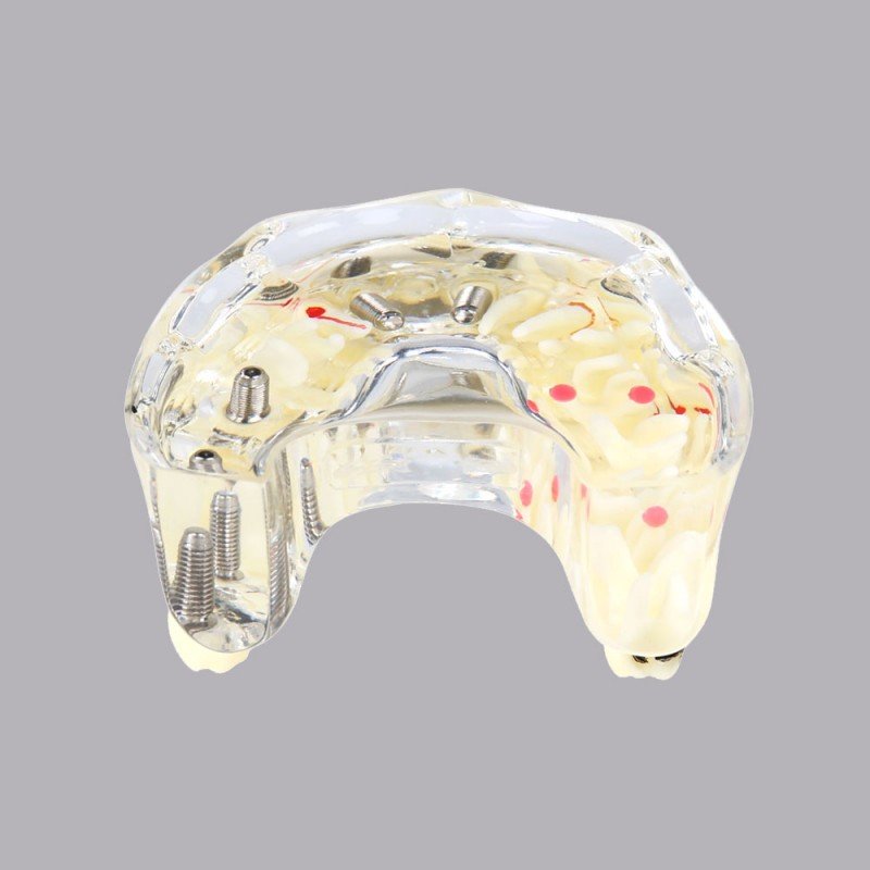 Implant model with soft gingiva and bridge - Image 3