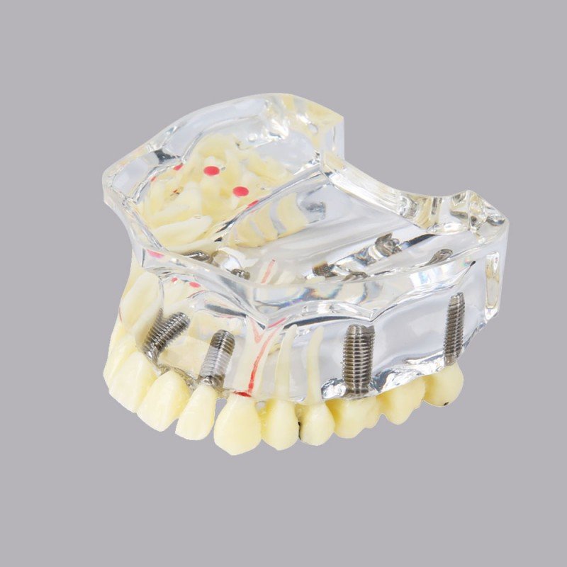 Implant model with soft gingiva and bridge - Image 2