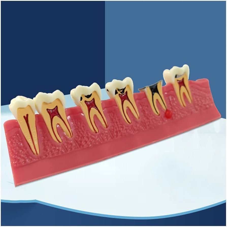 Caries Illustration Model