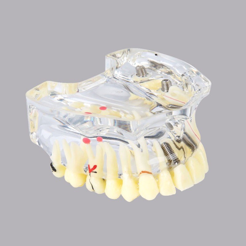 Implant model with soft gingiva and bridge