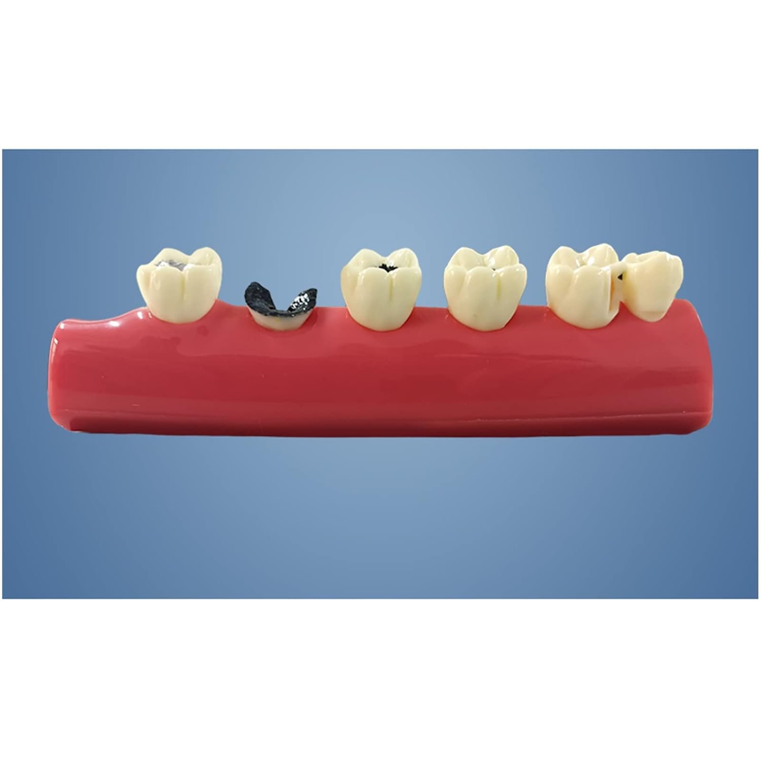 Caries Illustration Model - Image 6