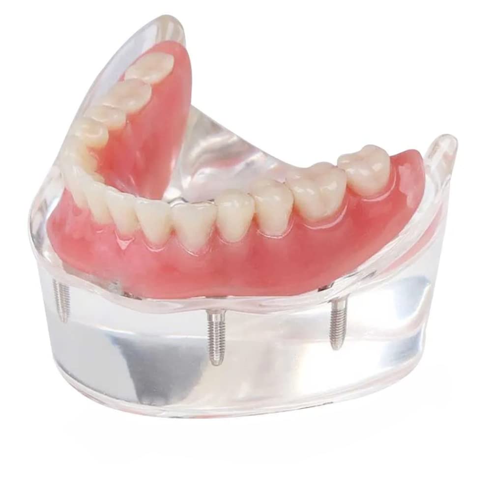 Unique Dents Overdenture Model with 4 Implants, Natural - Realistic look Implant Over Denture Model